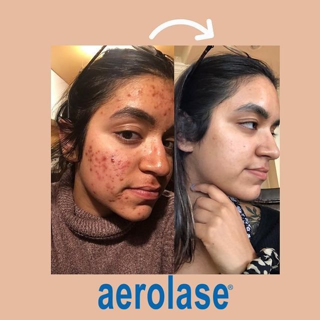 Aerolase-Acne