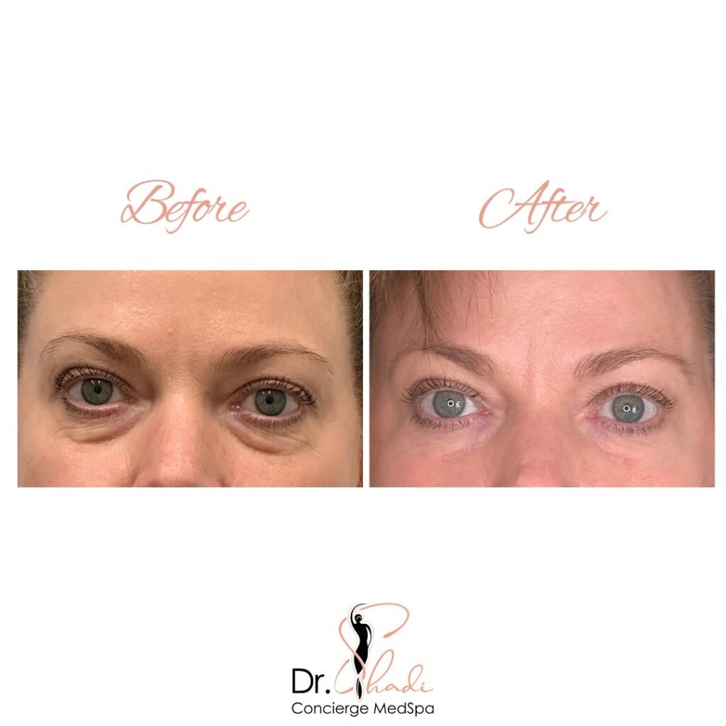 eye treatment before and after