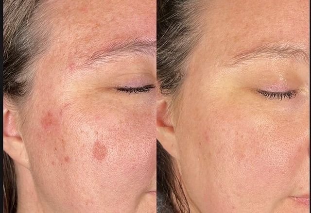 Hyperpigmentation by Aerolase