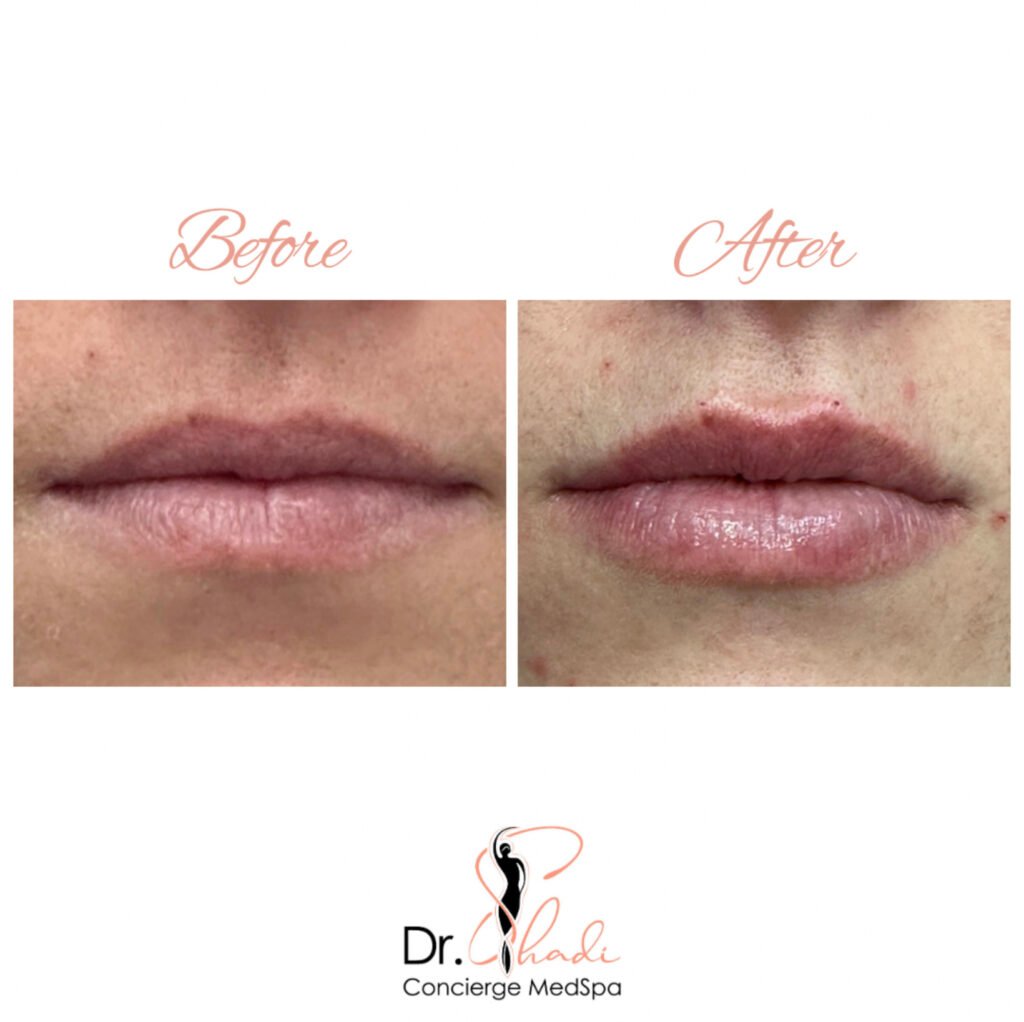 before and after lip treatment