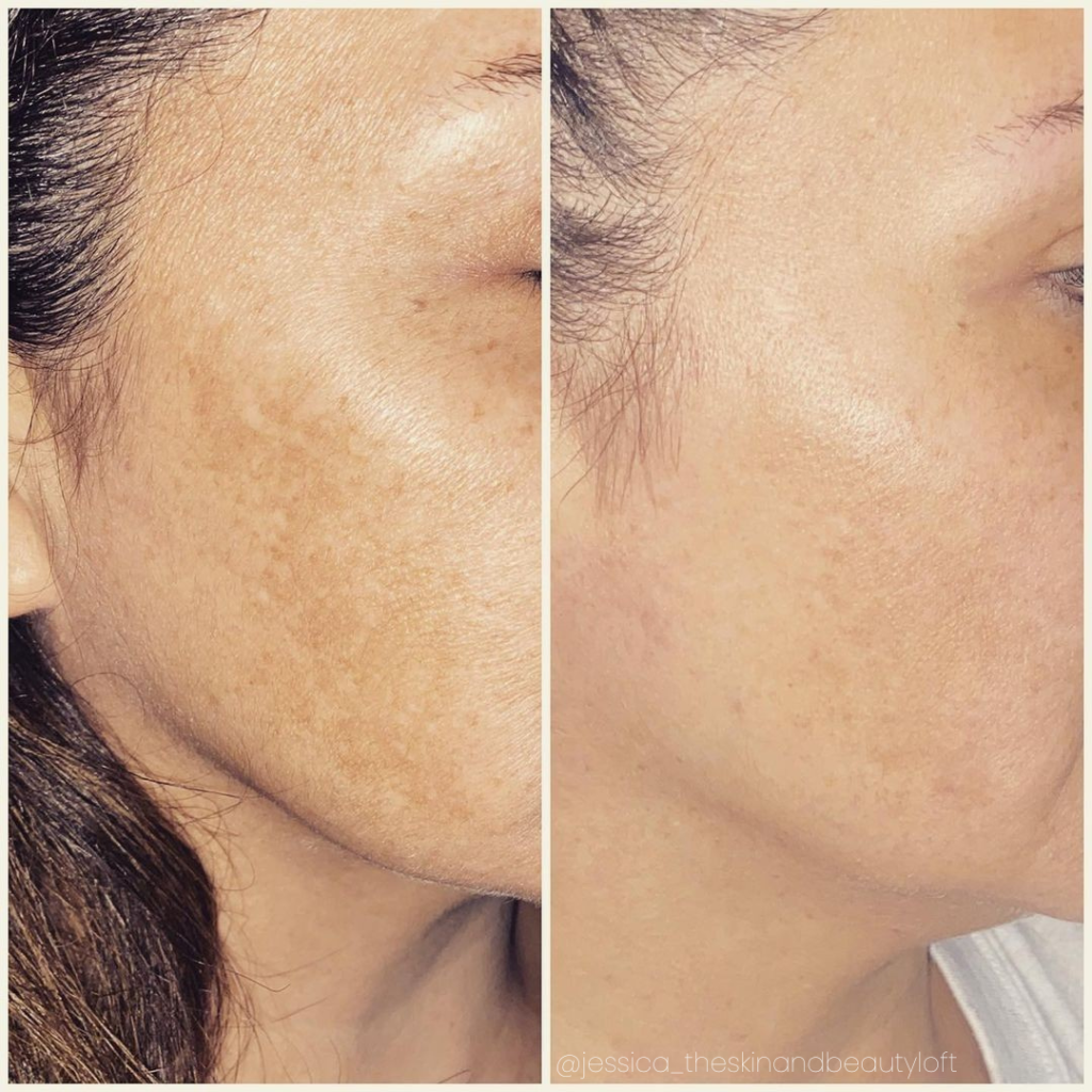 Melasma by Aerolase