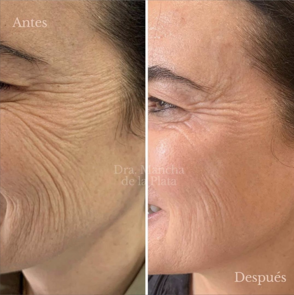 neo elite skin rejuvenation before and after