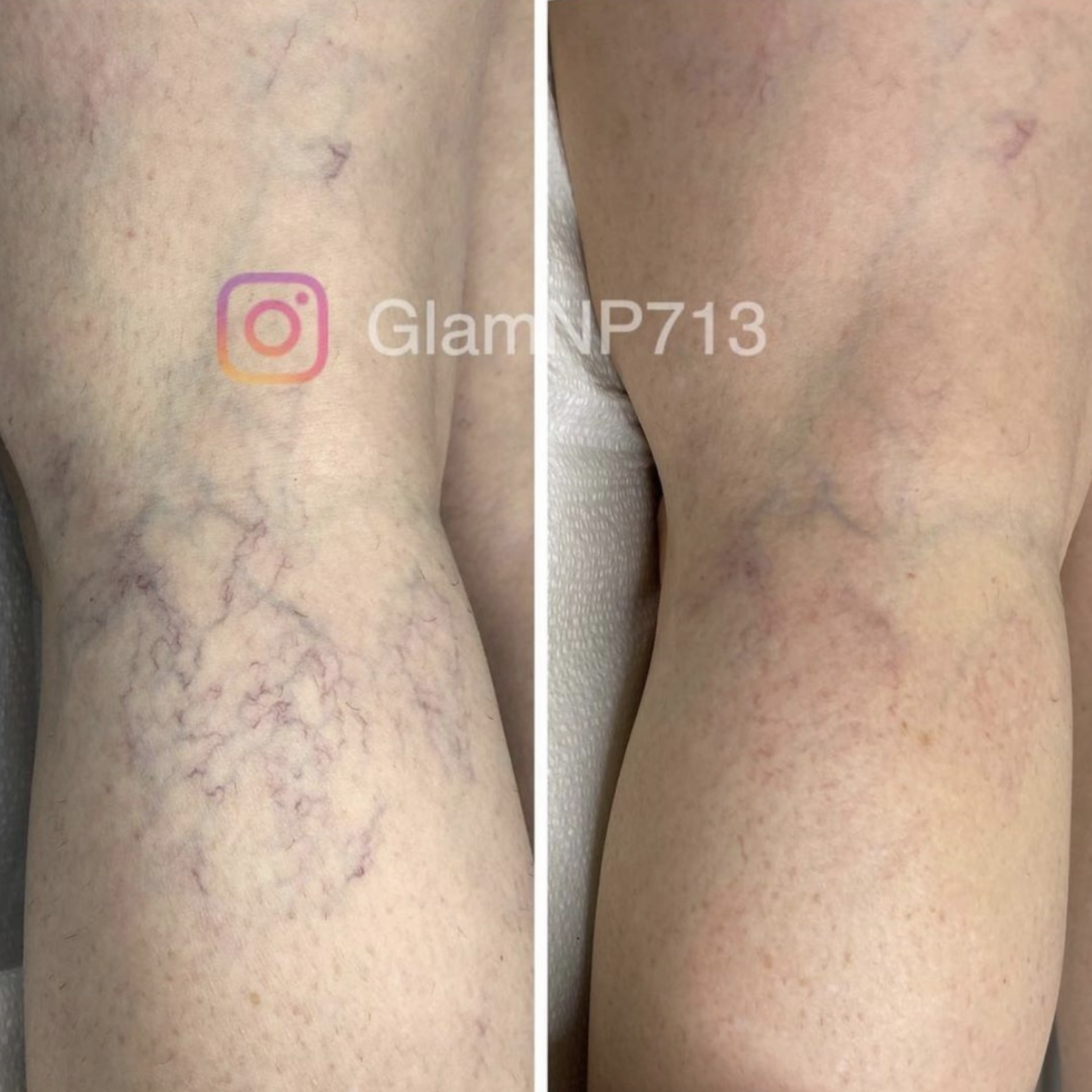 neo elite spider vein treatment