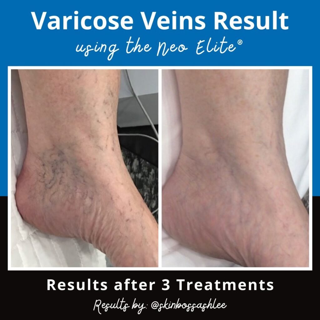 varicose veins result