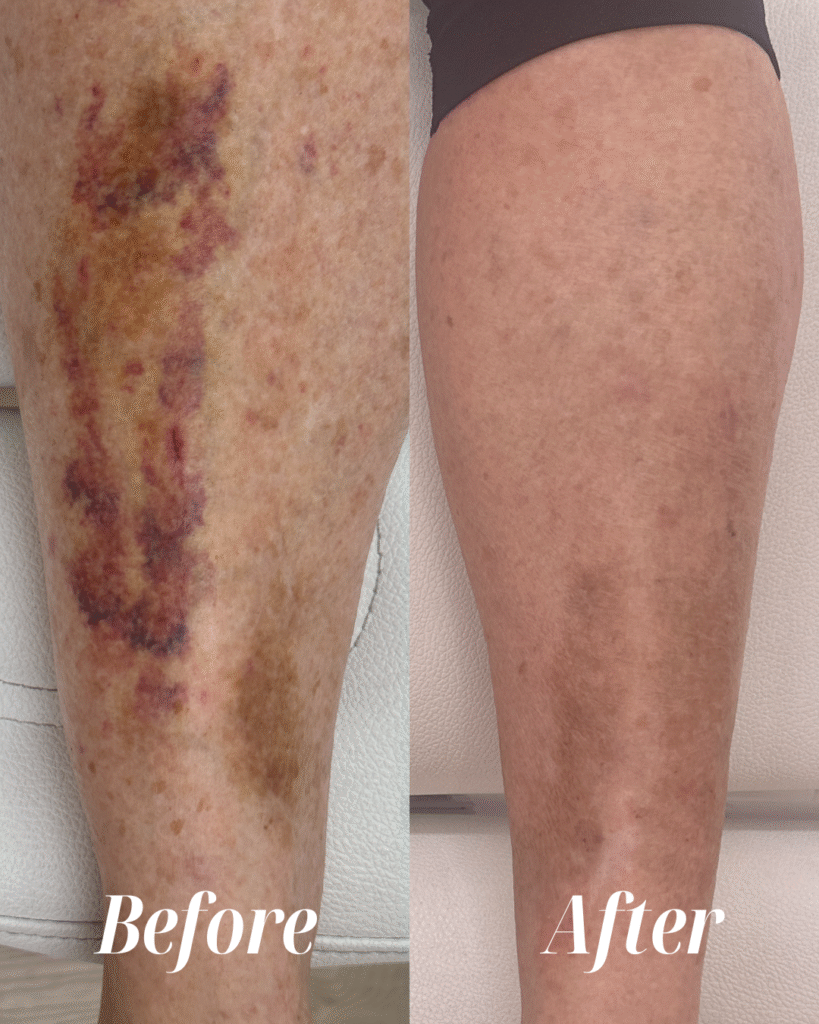 Aerolase Laser