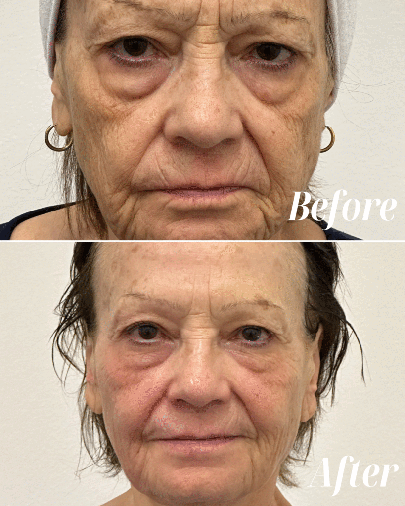 Full Face Rejuvenation - Botox, Radiofrequency Treatment, Sculptra