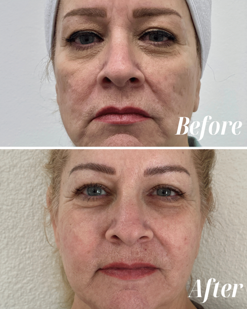 Full Face Rejuvenation - Radiofrequency Microneedling, Sculptra, Filler, Botox