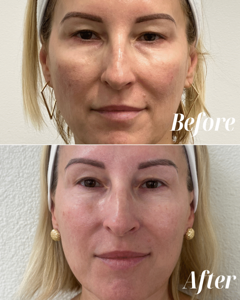 Full Face Rejuvenation - Radiofrequency Treatment, PRF Undereye Injection, Botox