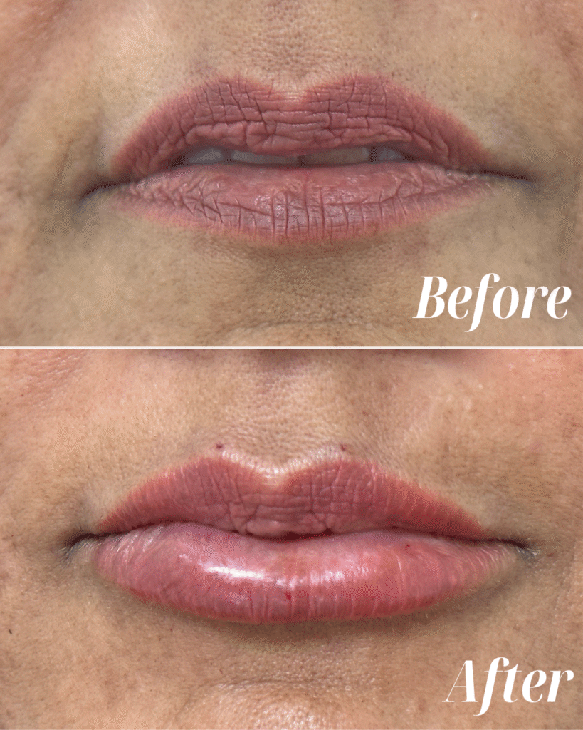 Lip Filler (2)