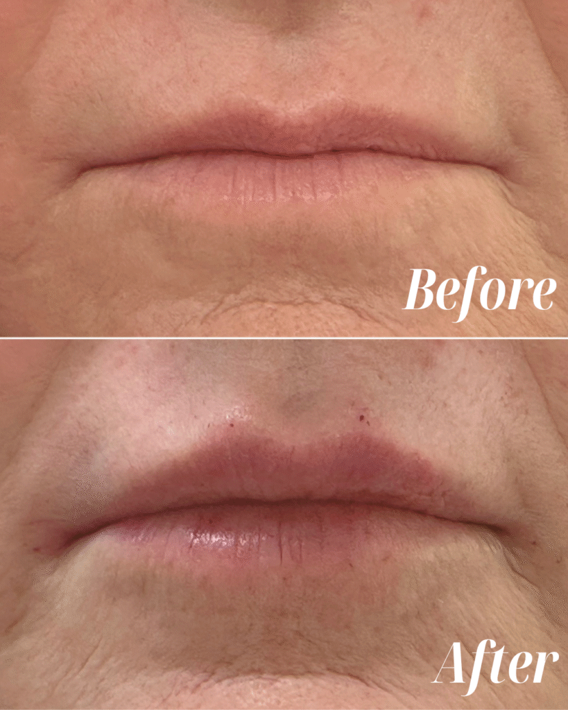 Lip Filler (3)