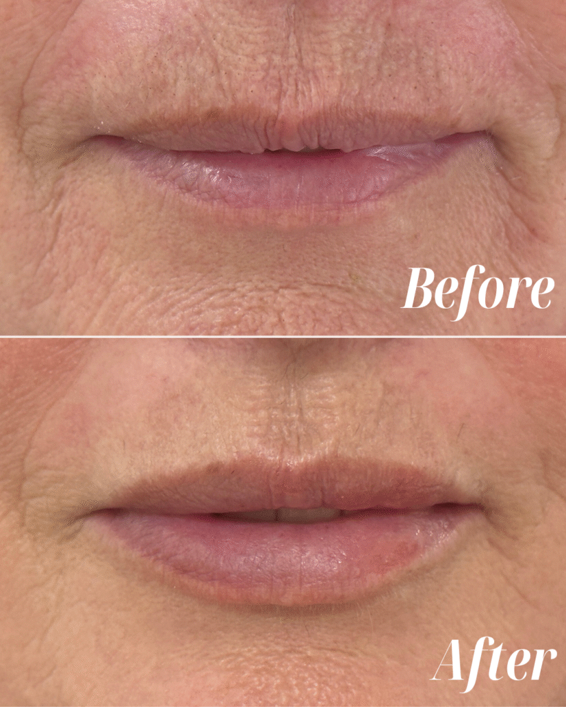 Lip Filler (4)