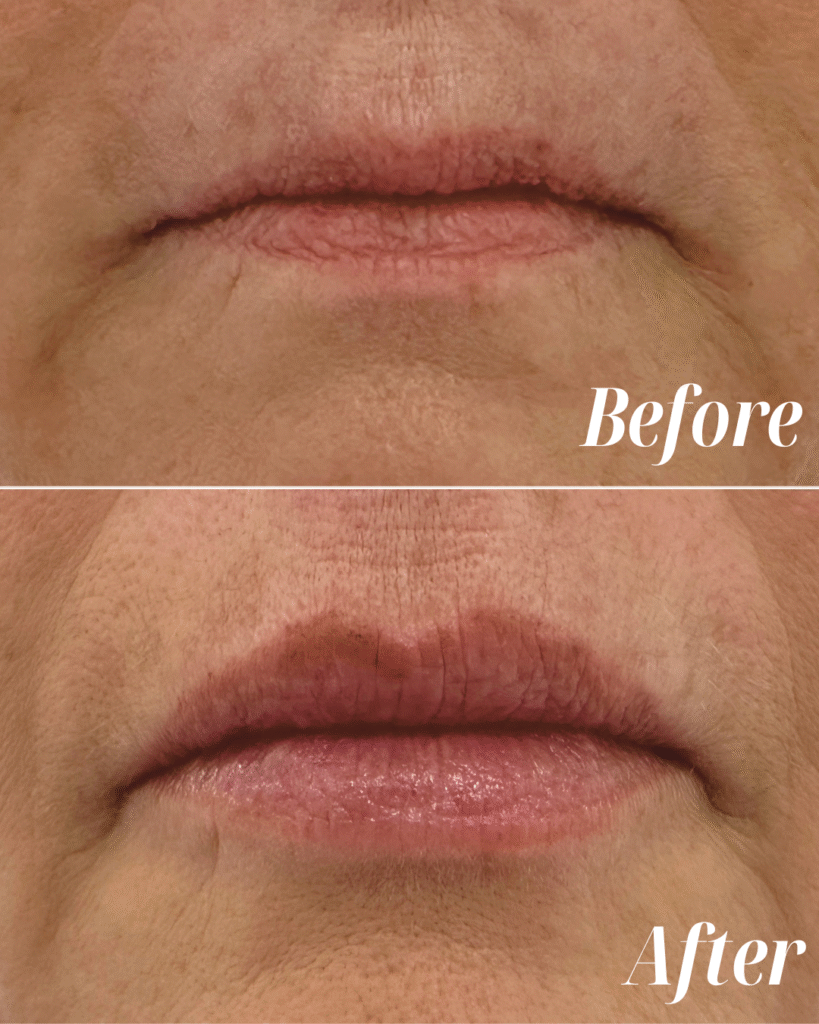 Lip Filler (5)
