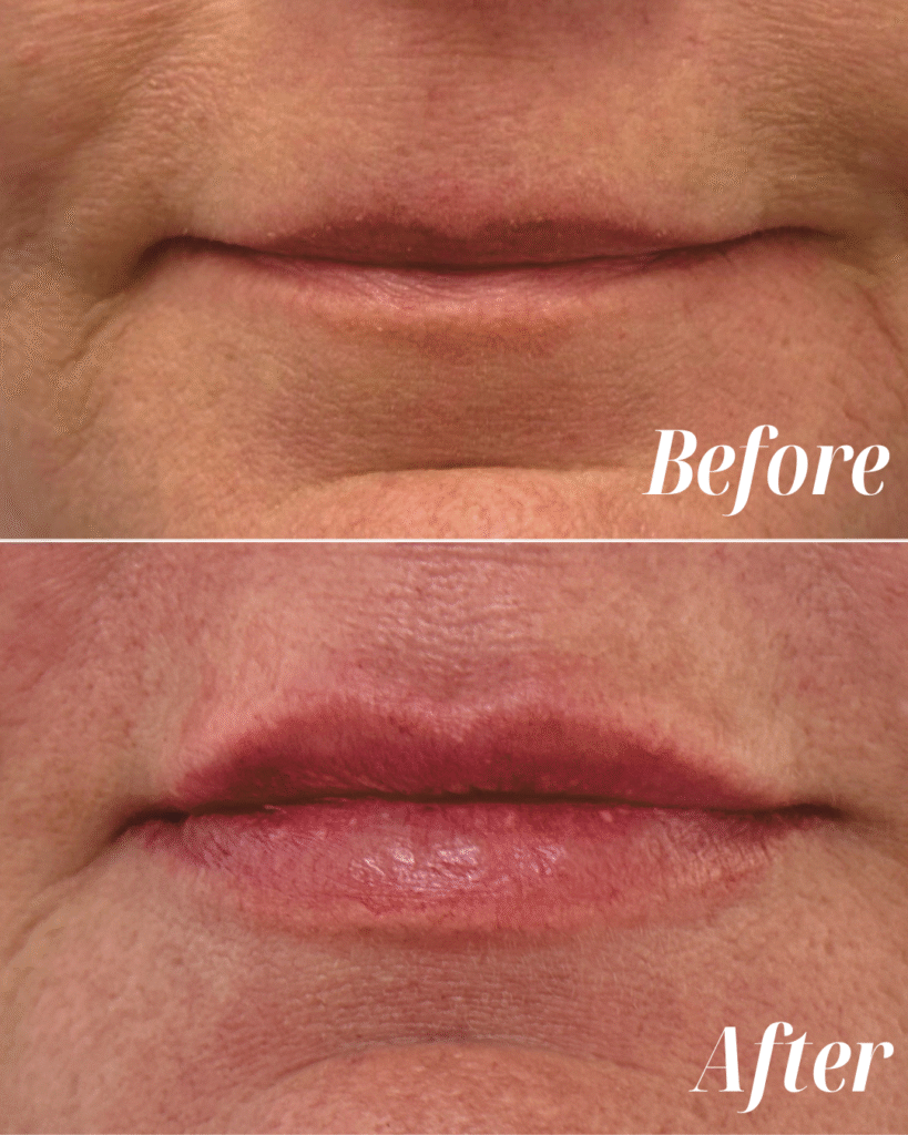Lip Filler (6)