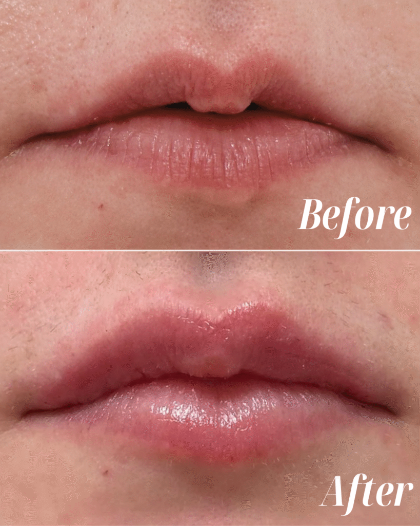 Lip Filler