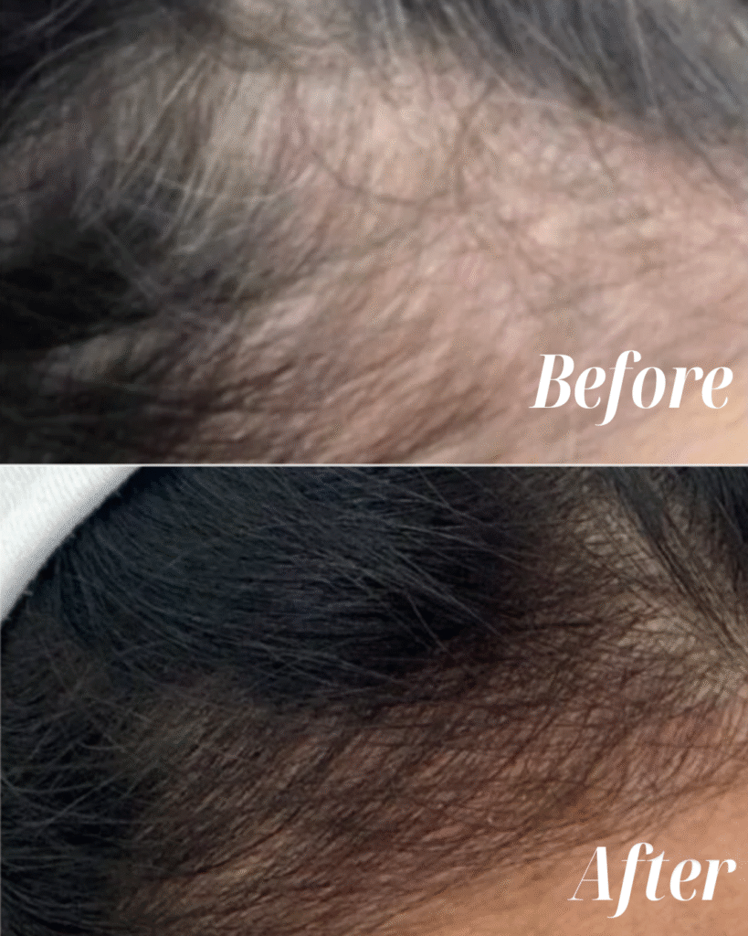 PRF Hair Restoration (2)