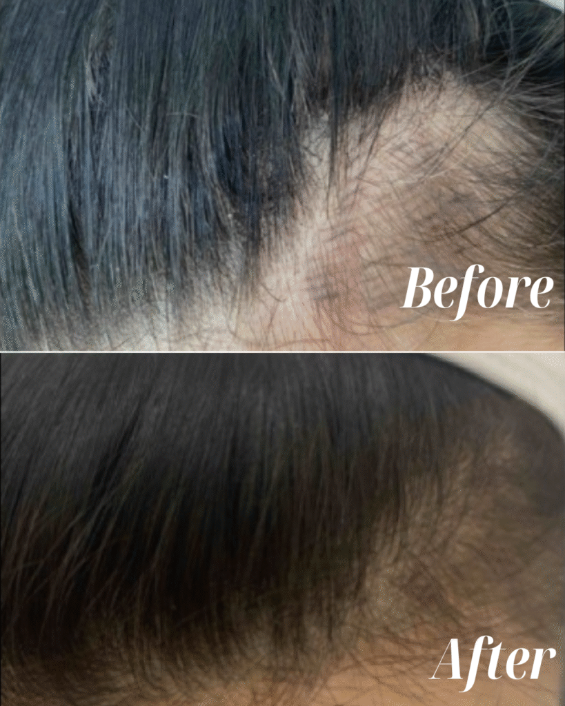 PRF Hair Restoration