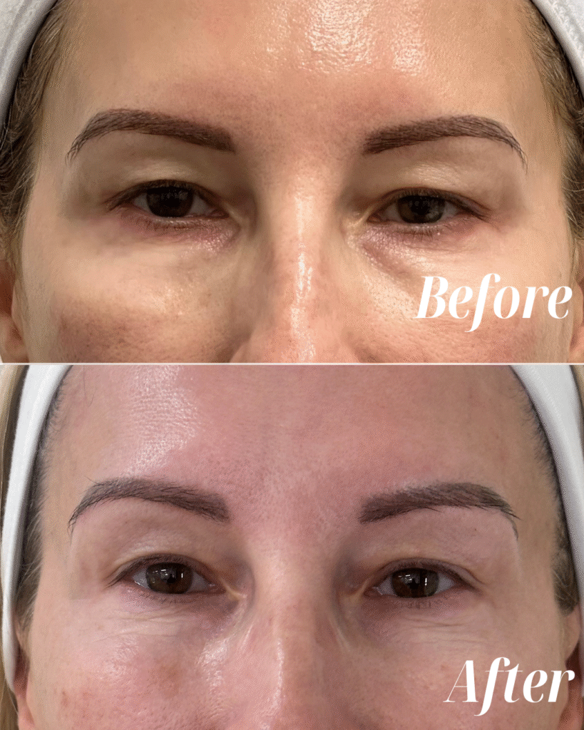 PRF Undereye
