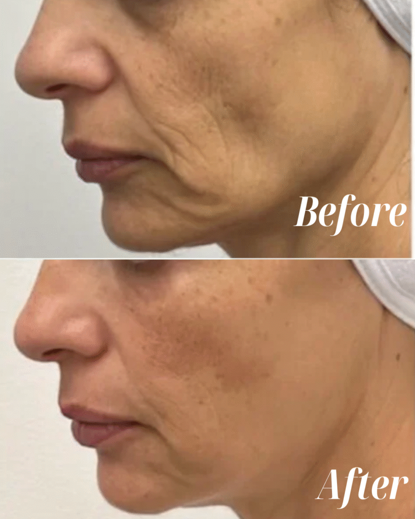 Sculptra