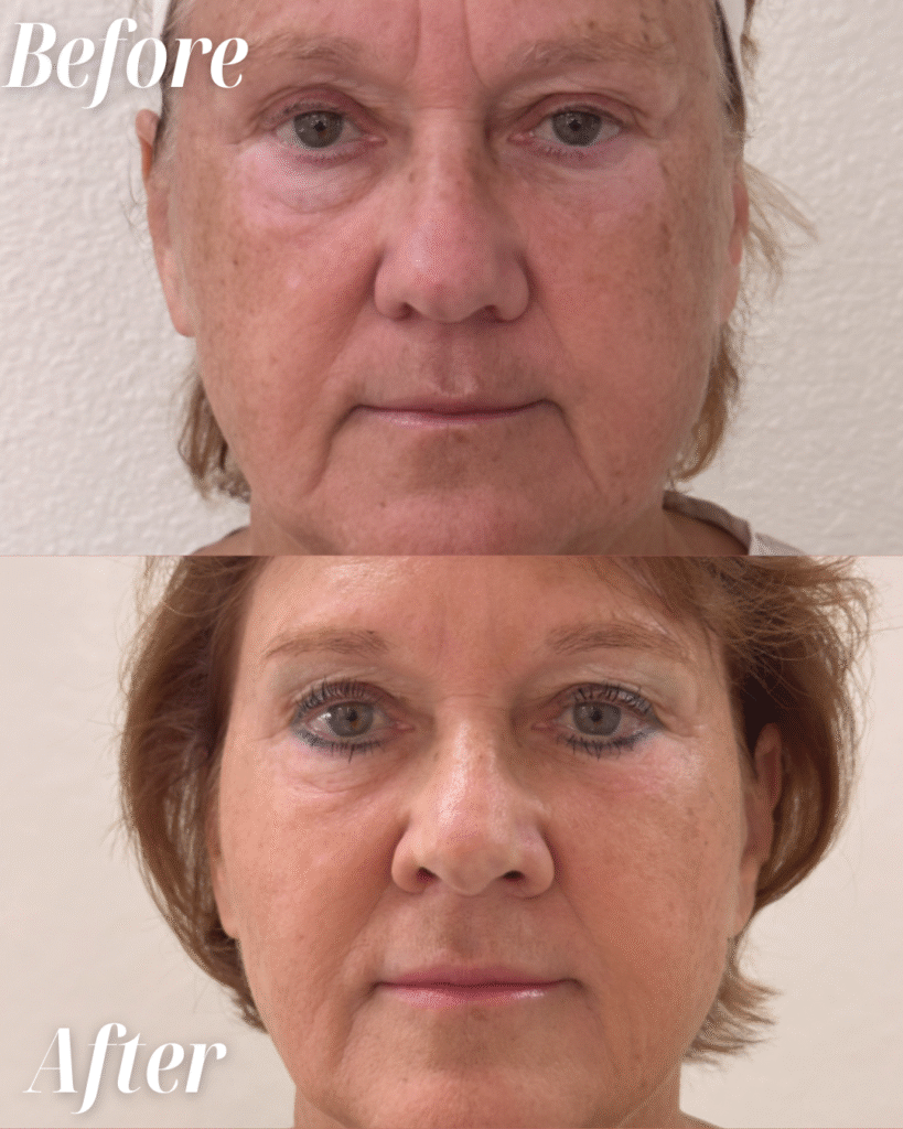 Full Face Rejuventation B & A