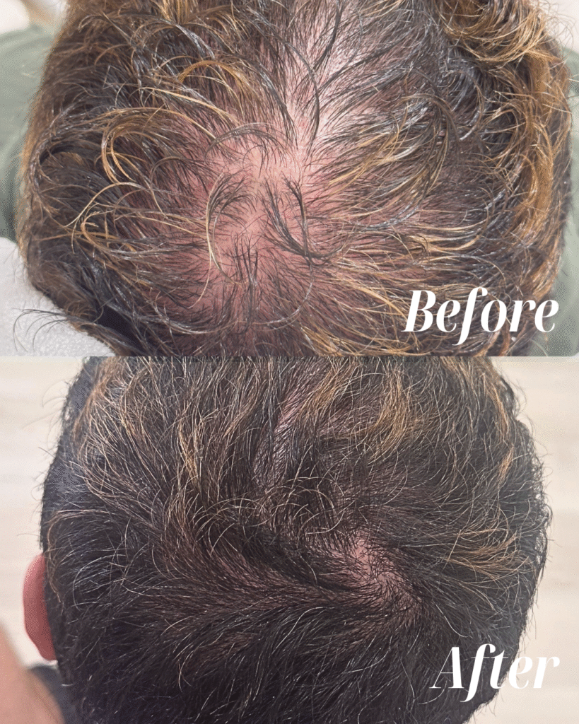 prf_hair_restoration